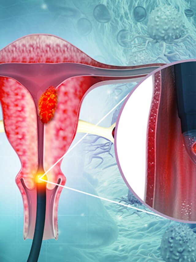 Read more about the article Understanding Cervical Cancer