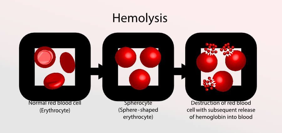 Understanding the Actual Reality of Hemolytic Anemia